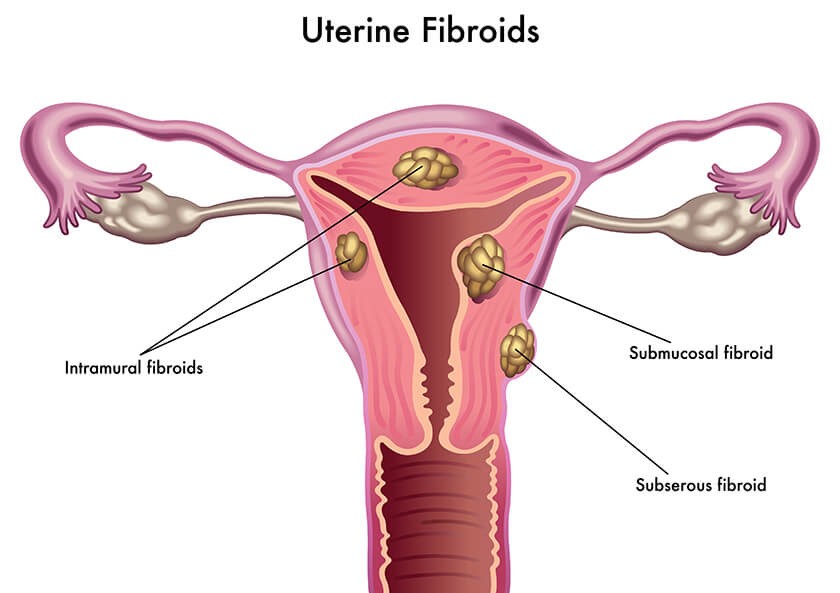 uterine-fibroid-example.jpg