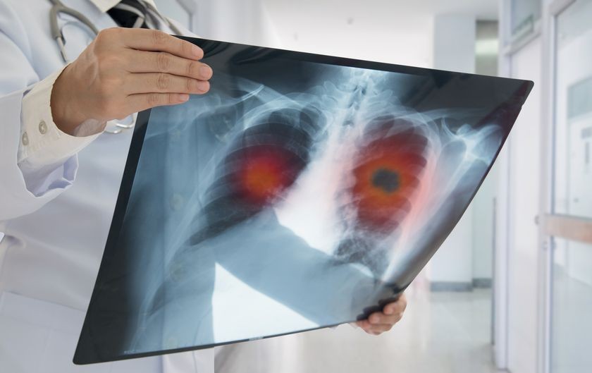 lung-cancer-xray.jpg