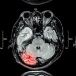mri-of-brain-injury.jpg