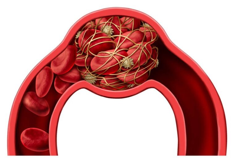 Diagnosing Dangerous Blood Clots with PET/CT Imaging - RAI