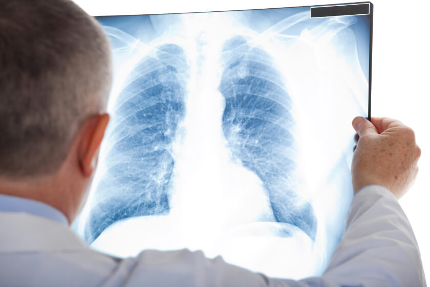 doctor-looking-at-lung-xray.jpg