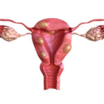 uterine-fibroids.jpg