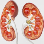 kidney-stones-2-1.jpg