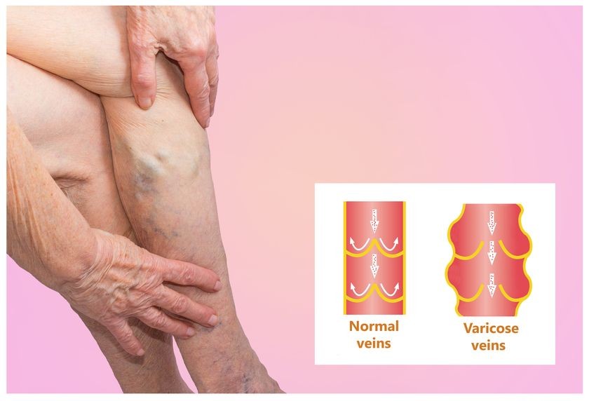 varicose-veins.jpg