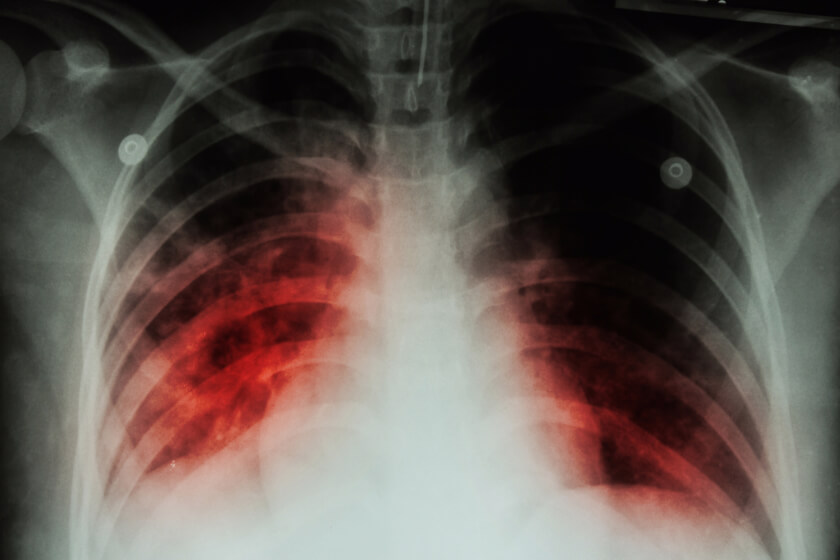 chest-xray.jpg