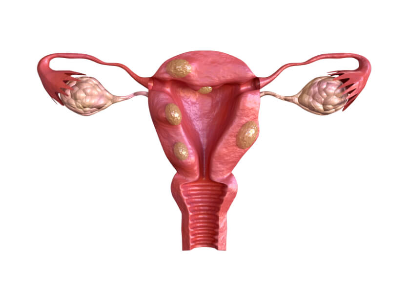 uterine-fibroids.jpg
